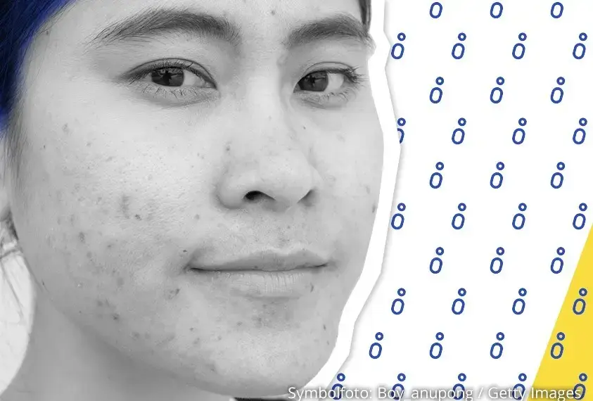 M&auml;dchen mit unreiner Haut