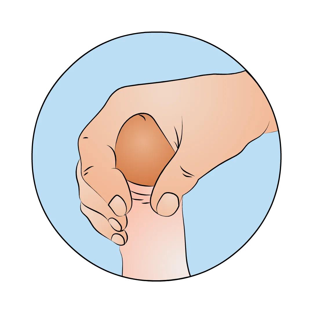 Illustration: Vorhaut zur&uuml;ckstreifen