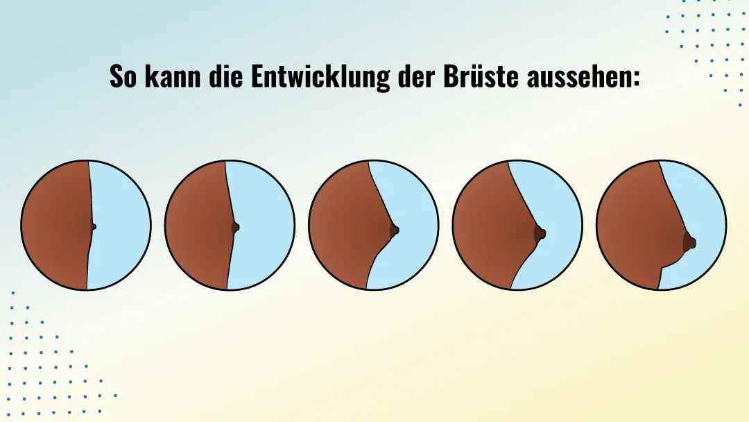 So kann die Entwicklung der Br&uuml;ste aussehen &ndash; schematische Darstellung einer m&ouml;glichen Brustentwicklung in f&uuml;nf Entwicklungsstufen von links nach rechts.